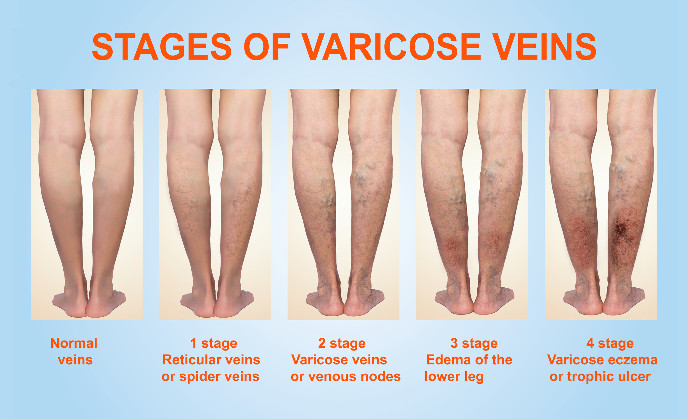 what-is-varicose-veins-how-its-occur-varicose-veins-my-xxx-hot-girl